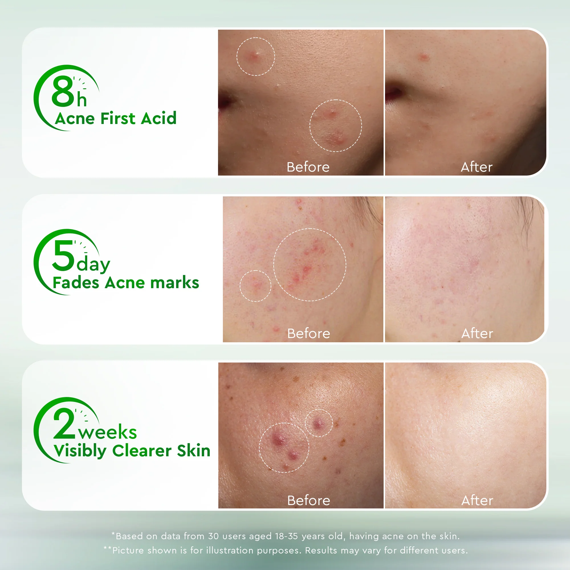Acne Drying Lotion - Image 4